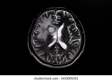 MRI Scan Of The Brain Show Intracerebral Hemorrhage Of Patient Stroke.