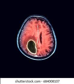 MRI scan of the brain, showing brain abscess (or cerebral abscess)
