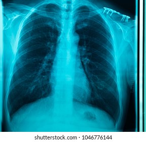 MRI Scan Broken Collar Bone (Broken Clavicle), Human Body Xray Monitor