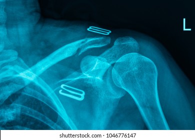 MRI Scan Broken Collar Bone (Broken Clavicle), Human Body Xray Monitor