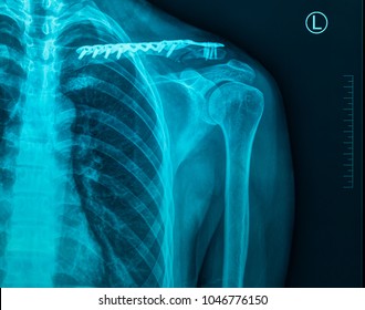 MRI Scan Broken Collar Bone (Broken Clavicle), Human Body Xray Monitor