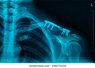 MRI Scan Broken Collar Bone (Broken Clavicle), Human Body Xray Monitor