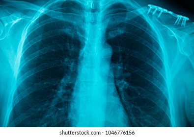 MRI Scan Broken Collar Bone (Broken Clavicle), Human Body Xray Monitor