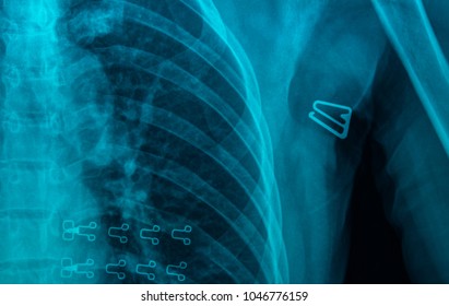 MRI Scan Broken Collar Bone (Broken Clavicle), Human Body Xray Monitor