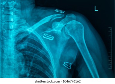 MRI Scan Broken Collar Bone (Broken Clavicle), Human Body Xray Monitor