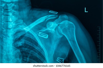 Mri Scan Broken Collar Bone Broken Stock Photo 1046776165 | Shutterstock