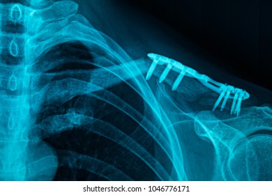 MRI Scan Broken Collar Bone (Broken Clavicle), Human Body Xray Monitor