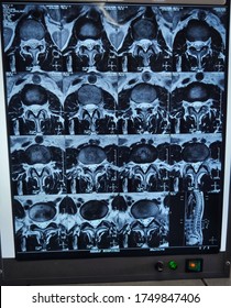 MRI Scan Copy Of A Transverse Section Of A Abdominal Level And Lumbar Region 