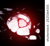 An MRI scan of the heart showing detailed cross-sectional anatomy, used for evaluating heart function and structure, providing a clear image of the heart chambers and surrounding tissues.