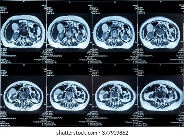 MRI Scan Of The Human Abdomen Organs