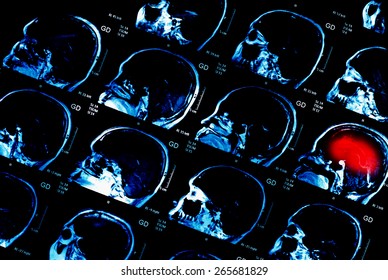 MRI Scan : Human Brain