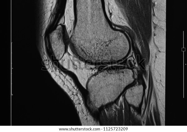 Mri Scan Image Knee Joint Stock Photo (Edit Now) 1125723209