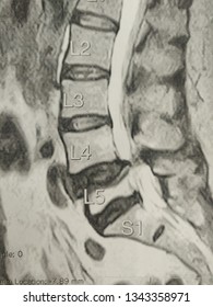 MRI Scan Of The Lumbar Spine. Listez, Fracture.