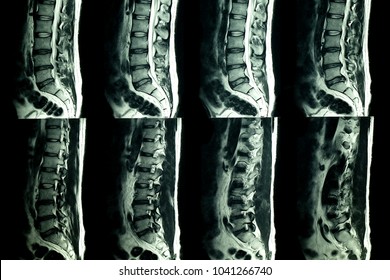 MRI scan of lumbar spines of a patient with chronic back pain showing degenerative change of lumbar and sacral spines with disc dessication and disc space narrowing and central bulging of L3-4 dis