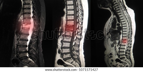 Mri Scan Lumbar Spines Patient Chronic Stock Photo (Edit Now) 1071571427