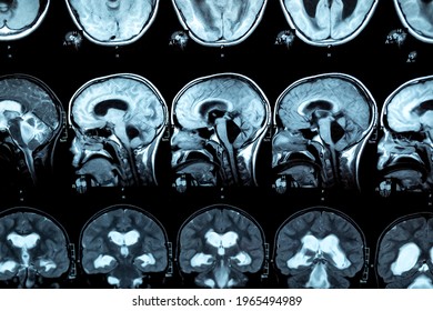 MRI Scan Or Magnetic Resonance Image Of The Brain Showed Obstructive Triventricular Hydrocephalus With Clinical Of Hydrocephalus: Cognitive Decline, Incontinence. Neurology, Medical Service Concept.