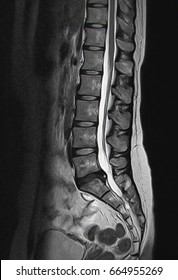 MRI scan sagittal view Lumbosacral spine has straightening lumbar alignment, L5-S1 is moderate posterior inferior disc protrusion causes bilateral S1 traversing root compression, Low back pain patient