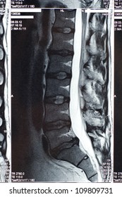 Mri; Mri Scan; Mri Scanner; Human Spine; Disk; Herniated