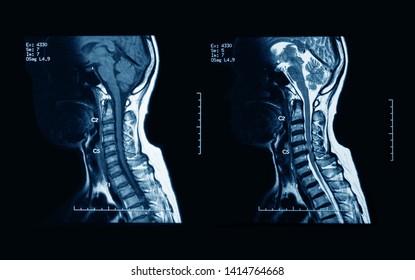MRI scans of the cervical spine, with and without contrast media, MRI with bilateral C7 nerve root compression, Cervical spondylosis.