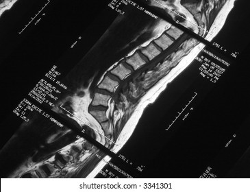 MRI Spine Scan