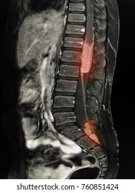 MRI Spine Showing Mass At Distal Cord And Conus Medullaris, With Tumor Seedings At Lower Spinal Canal. 
