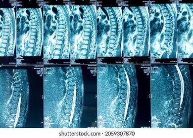 MRI Of The Thoracic Spine, Medical Examination