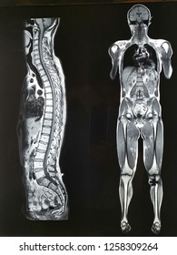 MRI Whole Body Scan Side Image And Front Image