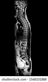 MRI Of Whole Spine  T2W Sagittal  Plane For Diagnostic Spinal Cord Compression.