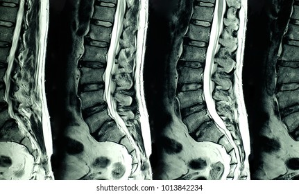 MRI xray film scan of sacro-lumbar spines of a patient with chronic back pain and weakness of leg. The MRI shows degenerative changes of L spines, lumbar discs herniation and nerve roots compression. 