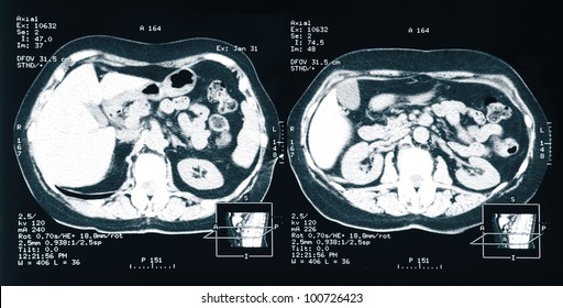 MRI.  X-ray Of The Human Kidney