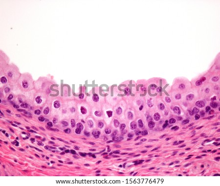 Mucosa of urinary bladder lined by transitional epithelium (urothelium). The superficial layer shows large cells with big nuclei, sometimes binucleated.