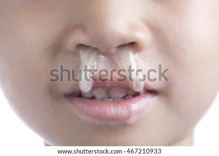 Mucus flowing from nose of young boy asian on white background.