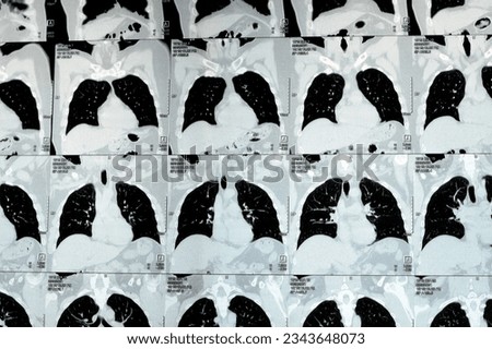Multi slice CT scan of the chest showing normal study, normal appearance of the lungs, parenchyma, pulmonary vasculature,  mediastinal structures, no adenopathy, no pleural effusion, no abnormality