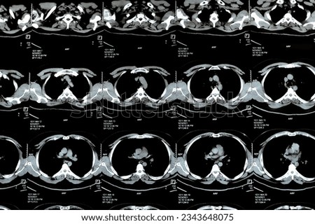Multi slice CT scan of the chest showing normal study, normal appearance of the lungs, parenchyma, pulmonary vasculature,  mediastinal structures, no adenopathy, no pleural effusion, no abnormality