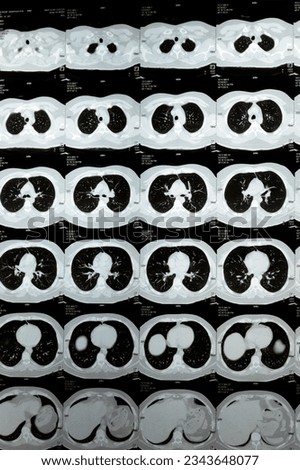 Multi slice CT scan of the chest showing normal study, normal appearance of the lungs, parenchyma, pulmonary vasculature,  mediastinal structures, no adenopathy, no pleural effusion, no abnormality