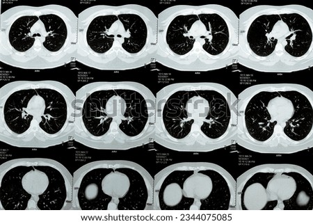 Multi slice CT scan of the chest showing normal study, normal appearance of the lungs, parenchyma, pulmonary vasculature,  mediastinal structures, no adenopathy, no pleural effusion, no abnormality