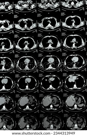 Multi slice CT scan of the chest showing normal study, normal appearance of the lungs, parenchyma, pulmonary vasculature,  mediastinal structures, no adenopathy, no pleural effusion, no abnormality