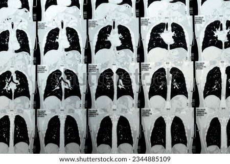 Multi slice CT scan of the chest showing normal study, normal appearance of the lungs, parenchyma, pulmonary vasculature,  mediastinal structures, no adenopathy, no pleural effusion, no abnormality