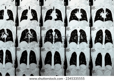 Multi slice CT scan of the chest showing normal study, normal appearance of the lungs, parenchyma, pulmonary vasculature,  mediastinal structures, no adenopathy, no pleural effusion, no abnormality