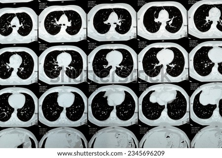 Multi slice CT scan of the chest showing normal study, normal appearance of the lungs, parenchyma, pulmonary vasculature,  mediastinal structures, no adenopathy, no pleural effusion, no abnormality