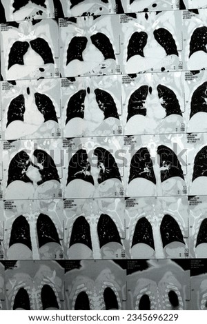 Multi slice CT scan of the chest showing normal study, normal appearance of the lungs, parenchyma, pulmonary vasculature,  mediastinal structures, no adenopathy, no pleural effusion, no abnormality