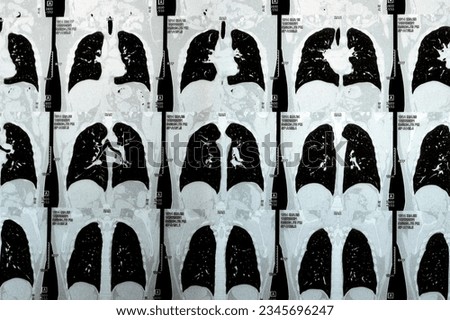 Multi slice CT scan of the chest showing normal study, normal appearance of the lungs, parenchyma, pulmonary vasculature,  mediastinal structures, no adenopathy, no pleural effusion, no abnormality