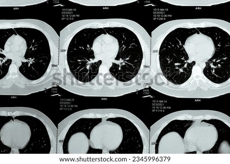 Multi slice CT scan of the chest showing normal study, normal appearance of the lungs, parenchyma, pulmonary vasculature,  mediastinal structures, no adenopathy, no pleural effusion, no abnormality