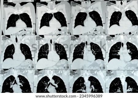 Multi slice CT scan of the chest showing normal study, normal appearance of the lungs, parenchyma, pulmonary vasculature,  mediastinal structures, no adenopathy, no pleural effusion, no abnormality