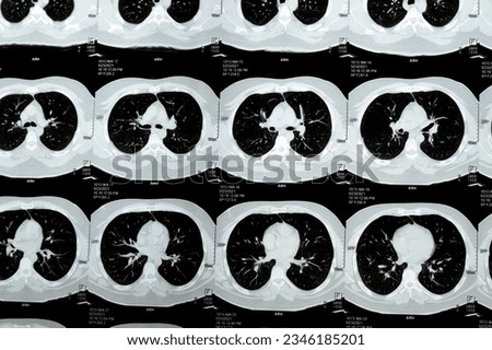 Multi slice CT scan of the chest showing normal study, normal appearance of the lungs, parenchyma, pulmonary vasculature,  mediastinal structures, no adenopathy, no pleural effusion, no abnormality
