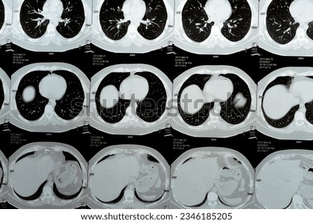 Multi slice CT scan of the chest showing normal study, normal appearance of the lungs, parenchyma, pulmonary vasculature,  mediastinal structures, no adenopathy, no pleural effusion, no abnormality