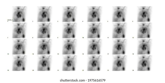 Multigate Acquisition(MUGA) Technetium Labeled RBC Scan In Vivo Technic In Nuclear Medicine Department