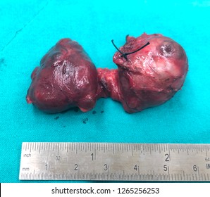 Multinodular Goiter Post Total Thyroidectomy