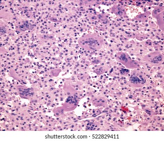 Multinucleated Giant Cells. Light Micrograph Of A Giant Cell Tumour Of Bone Showing Giant Cells Derived From Osteoclasts.