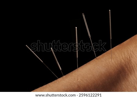 Multiple acupuncture needles inserted into skin. Traditional Chinese medicine treatment for pain relief and holistic healing. Alternative therapy and natural healthcare concept.